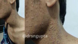 Acne Vulgaris Deciphering the Biology and Management of the World’s Most Common Skin Condition