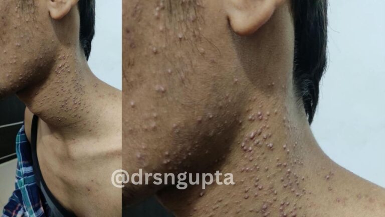 Acne Vulgaris Deciphering the Biology and Management of the World’s Most Common Skin Condition