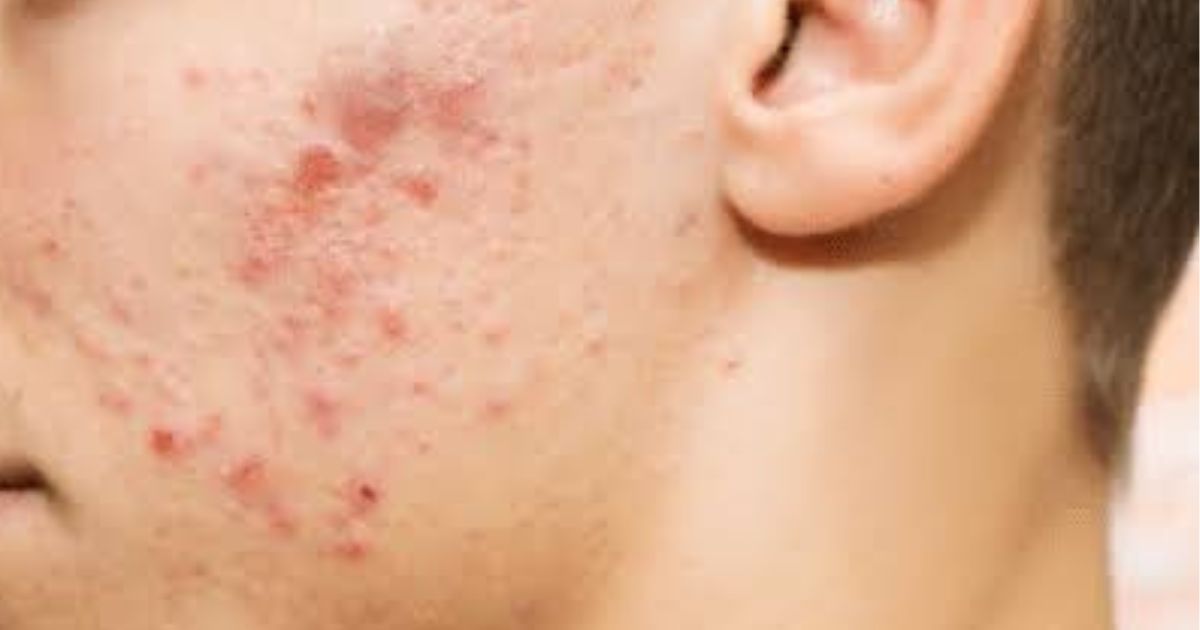 Acne Vulgaris Deciphering the Biology and Management of the World’s Most Common Skin Condition