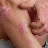 Inflammatory Skin Diseases