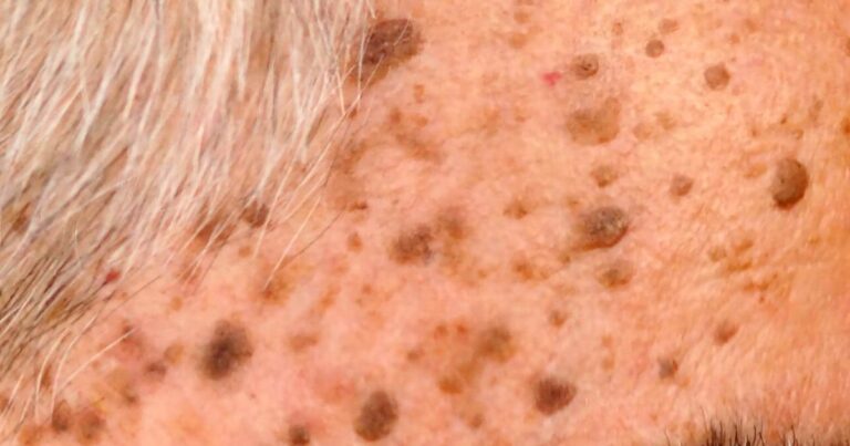 Understanding Benign Skin Growths When to Be Concerned and When to Relax