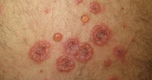 Understanding Bullous Diseases Navigating Blistering Skin Conditions