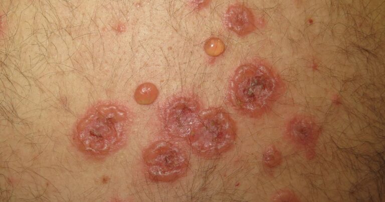 Understanding Bullous Diseases Navigating Blistering Skin Conditions