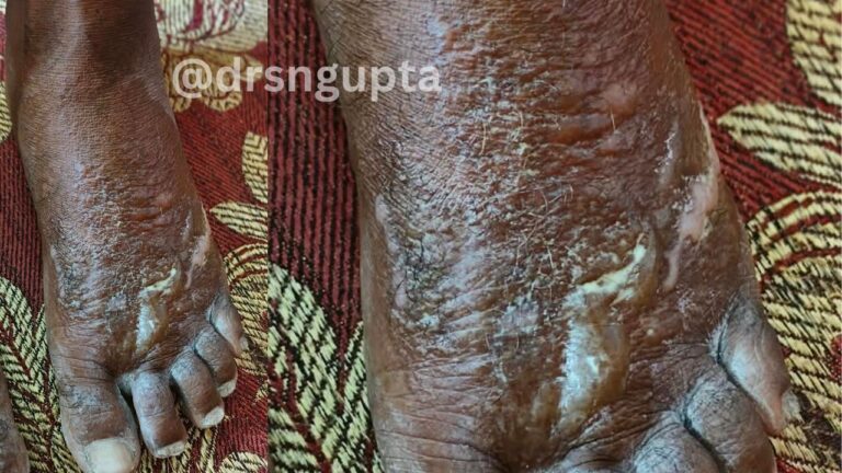 Understanding Eczema Navigating the Complexities of Dermatitis
