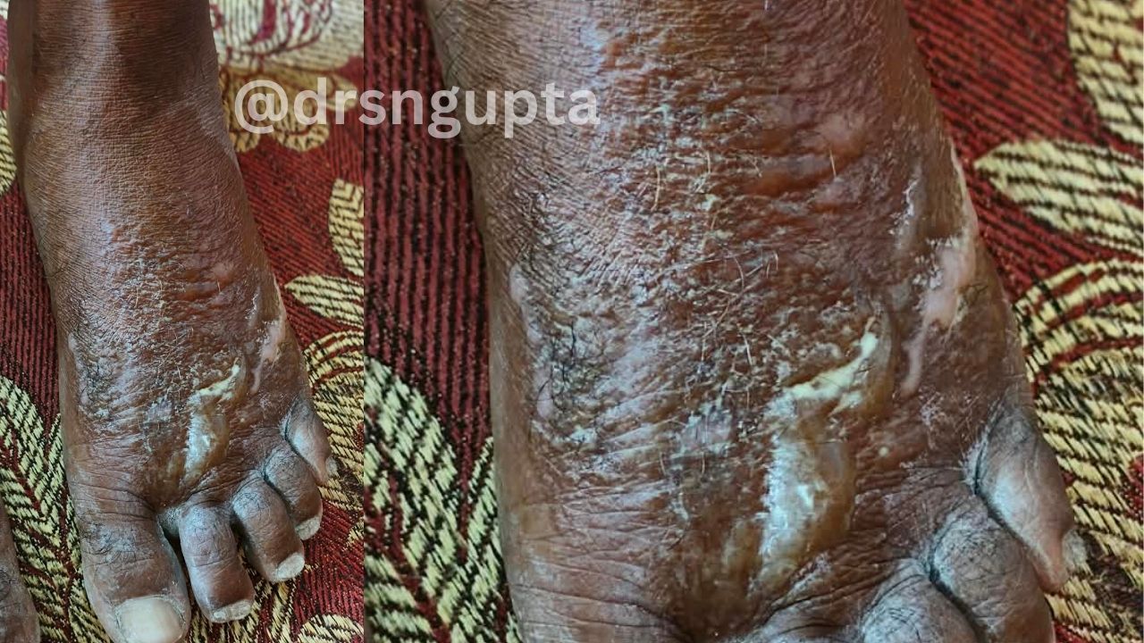 Understanding Eczema Navigating the Complexities of Dermatitis