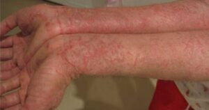 Understanding Eczema Navigating the Complexities of Dermatitis