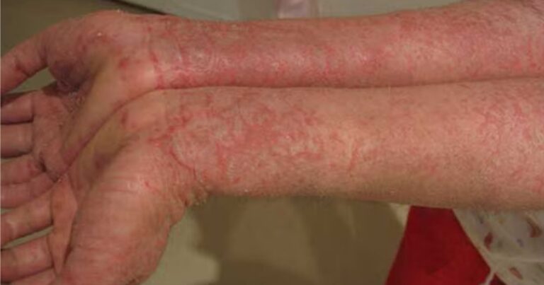 Understanding Eczema Navigating the Complexities of Dermatitis