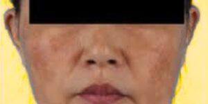 Understanding Melasma Pathogenesis, Clinical Presentation, and Comprehensive Management Strategies