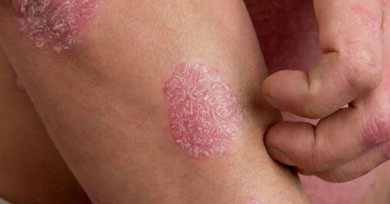 Understanding Psoriasis A Comprehensive Guide to Symptoms, Causes, and Management