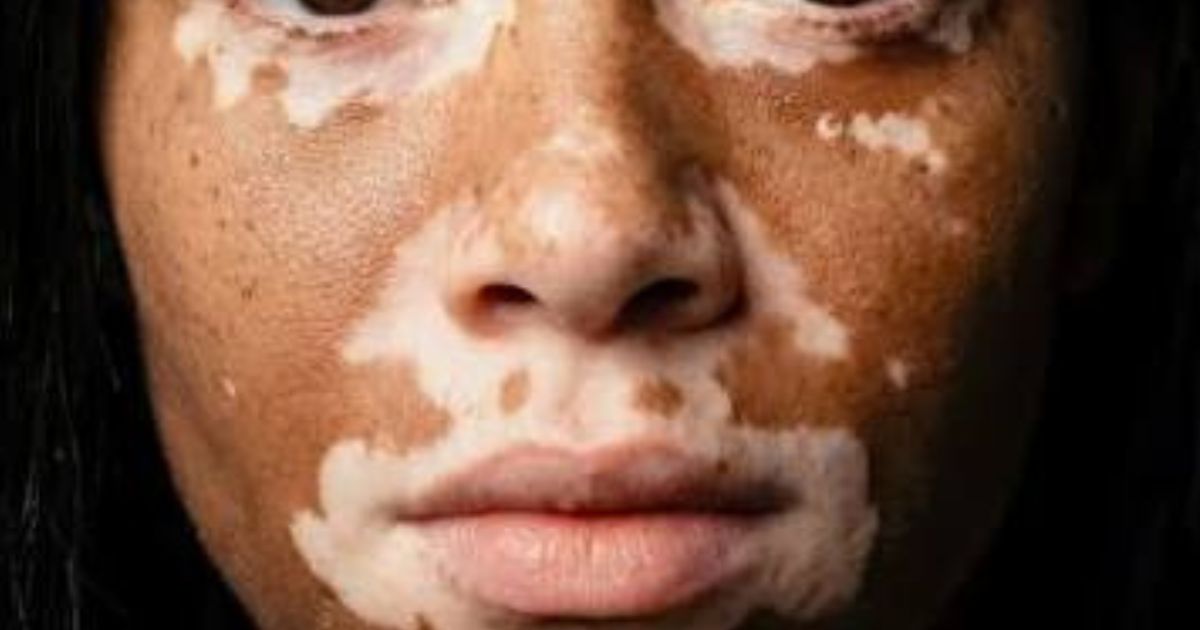 Understanding Vitiligo Beyond the Surface of Pigment Loss