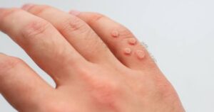 Understanding Warts Causes, Types, and Management