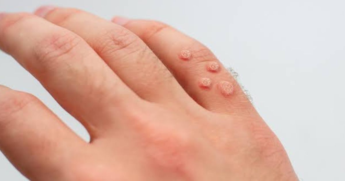 Understanding Warts Causes, Types, and Management