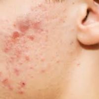 Disorders of Skin Appendages