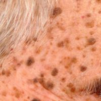 Neoplastic Skin Diseases (Growths & Cancer)