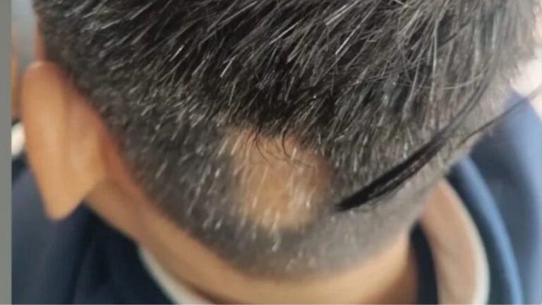 Alopecia Areata Guide Causes, Symptoms & New JAK Inhibitors