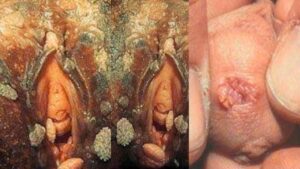 Demystifying Venereal Warts (Condyloma Acuminata) Causes, Symptoms, and Modern Clinical Solutions