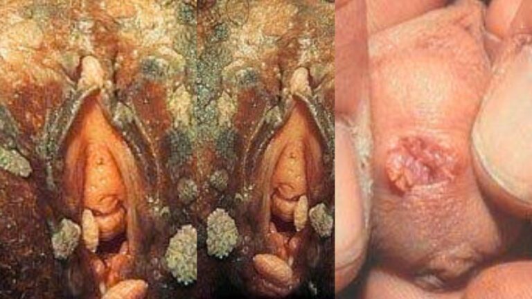 Demystifying Venereal Warts (Condyloma Acuminata) Causes, Symptoms, and Modern Clinical Solutions