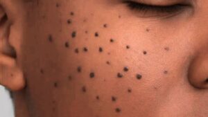 Dermatosis Papulosa Nigra (DPN) Causes, Symptoms, and Safe Removal Options
