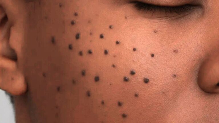 Dermatosis Papulosa Nigra (DPN) Causes, Symptoms, and Safe Removal Options