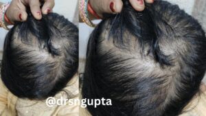 Female Androgenetic Alopecia (Female Pattern Hair Loss) Comprehensive Guide to Causes, Diagnosis, and Advanced Treatments