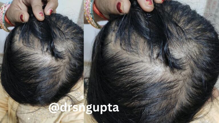 Female Androgenetic Alopecia (Female Pattern Hair Loss) Comprehensive Guide to Causes, Diagnosis, and Advanced Treatments