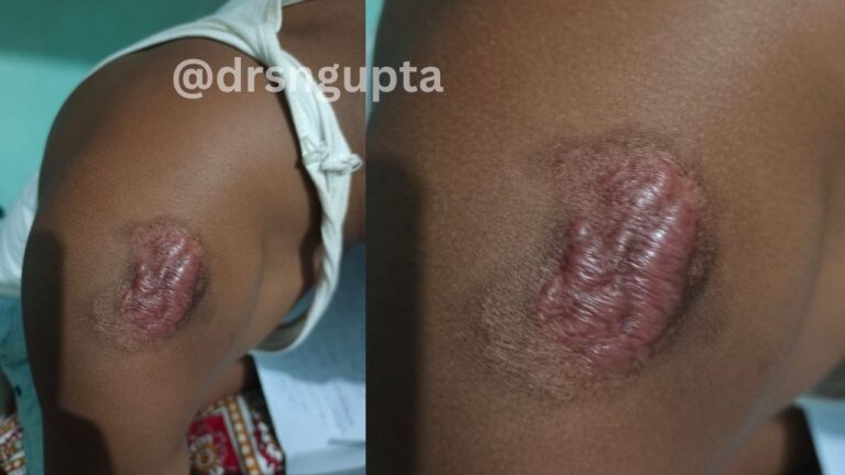 Keloids Causes, Symptoms, and Advanced Treatment Options -Dr S.N.Gupta