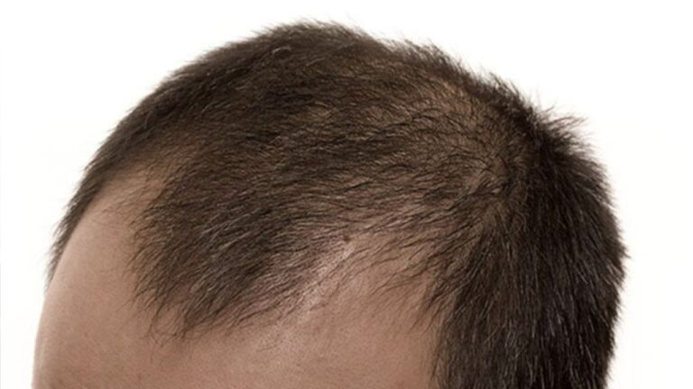 Male Androgenetic Alopecia Causes, Stages & Best Treatments