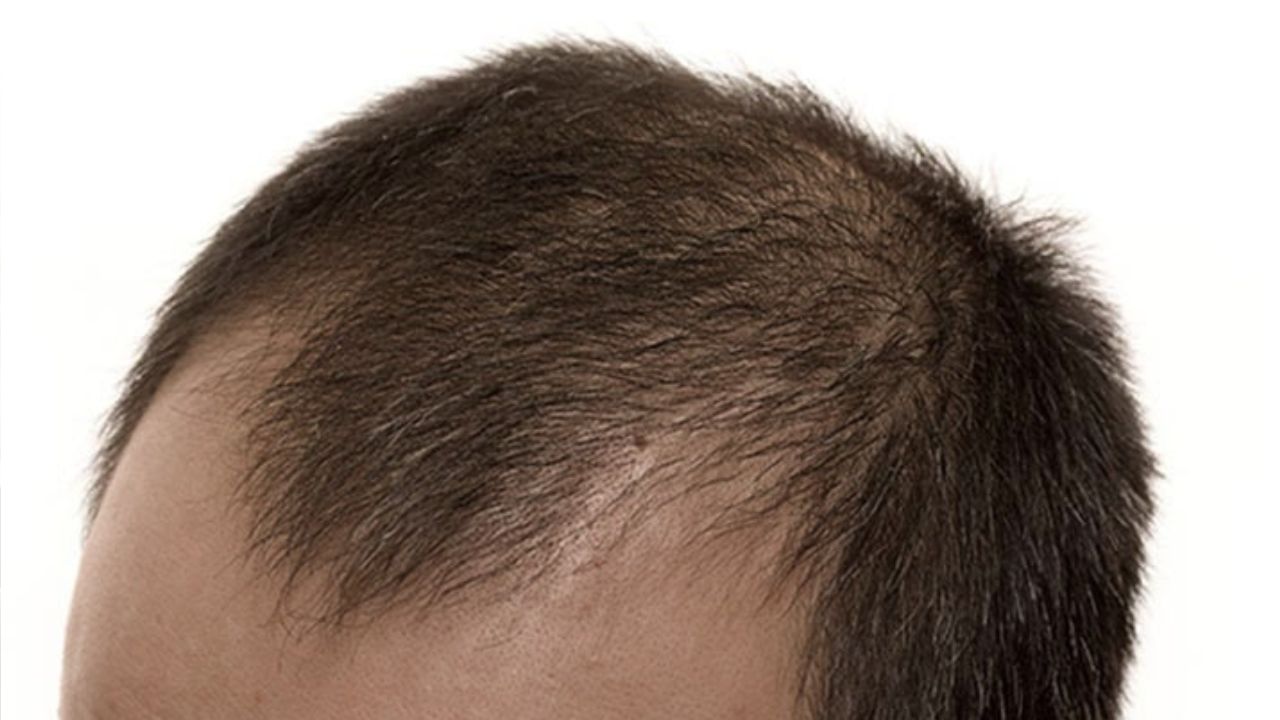 Male Androgenetic Alopecia Causes, Stages & Best Treatments