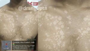 Pityriasis Versicolor Causes, Symptoms, Treatment, and Prevention