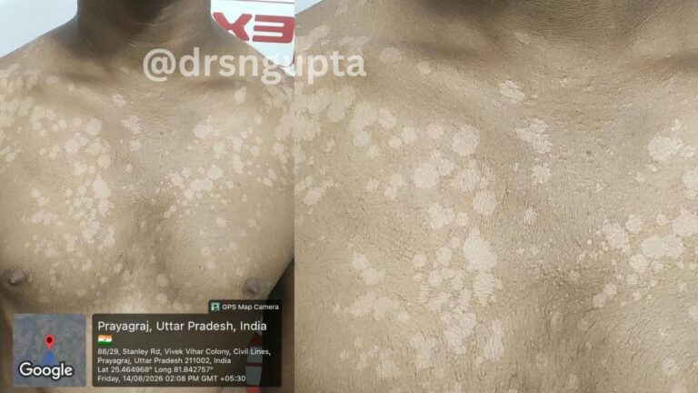 Pityriasis Versicolor Causes, Symptoms, Treatment, and Prevention