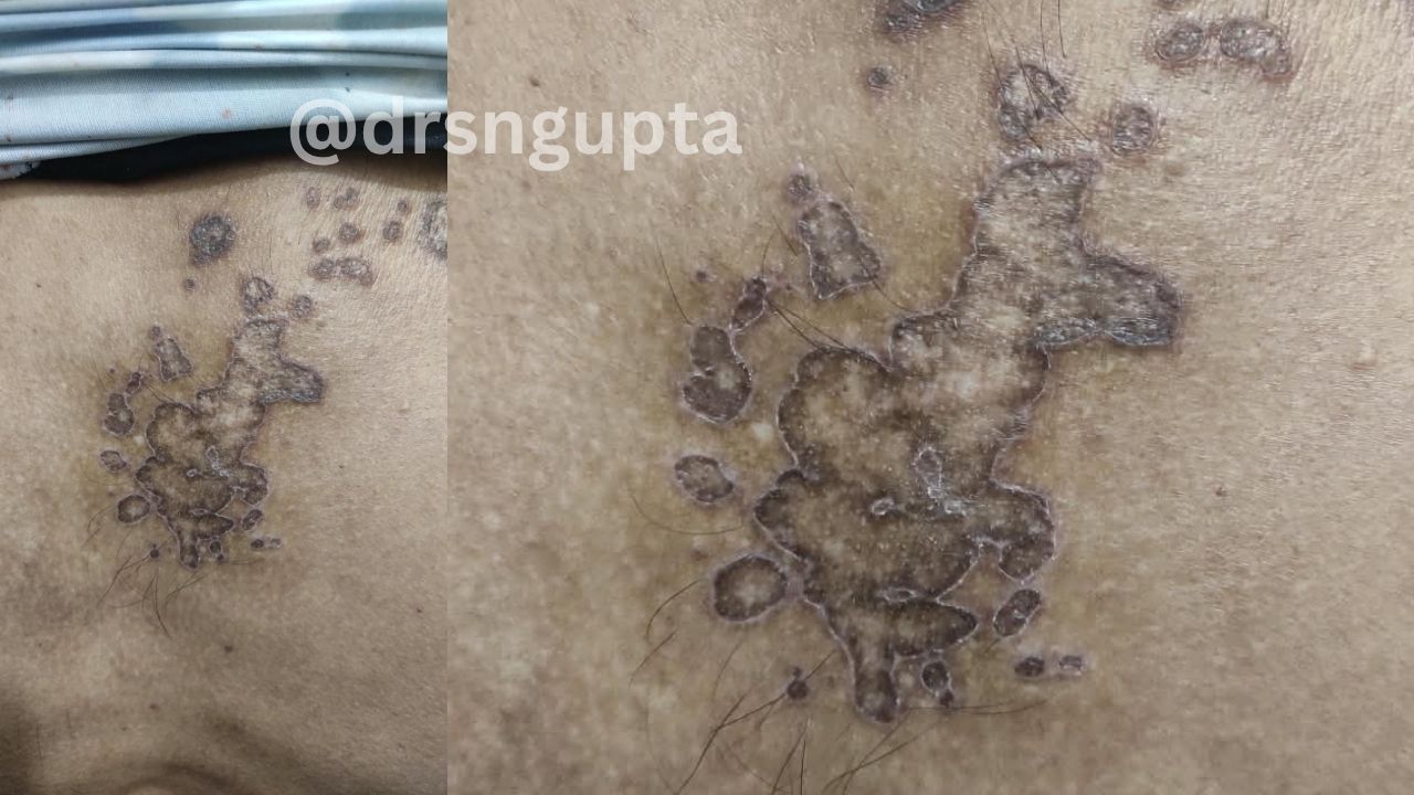 Porokeratosis Types, Symptoms, Causes, and Management - Dr S.N. Gupta