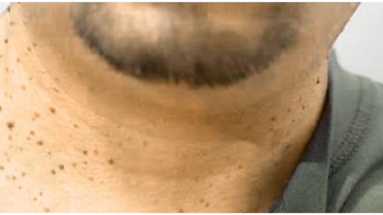 Skin Tags Understanding Causes, Symptoms, and Safe Removal Options