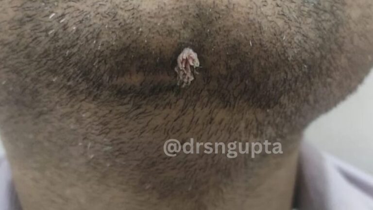 Understanding Filiform Warts (Verruca Filiformis) Causes, Distinct Symptoms, and Expert Removal Options