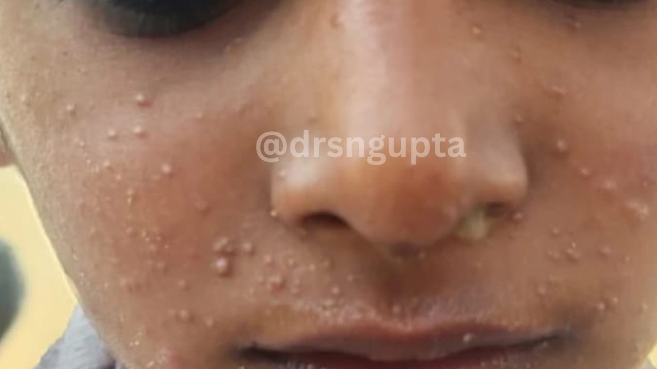 Understanding Molluscum Contagiosum Causes, Symptoms, and Effective Treatment Pathways
