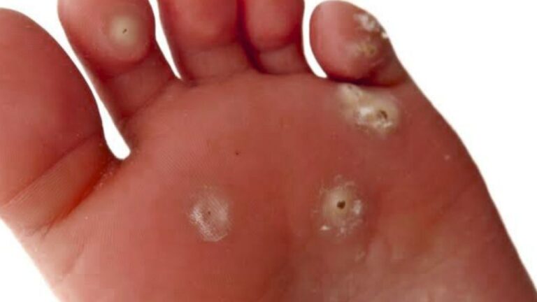 Understanding Plantar Warts (Verruca Plantaris) Causes, Symptoms, and Advanced Treatment Pathways