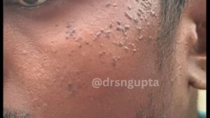 Understanding Verruca Plana (Flat Warts) Causes, Symptoms, and Advanced Treatment Solutions