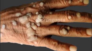 Understanding Verruca Vulgaris (Common Warts) Causes, Symptoms, and Advanced Treatment Solutions