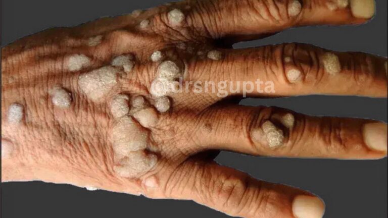 Understanding Verruca Vulgaris (Common Warts) Causes, Symptoms, and Advanced Treatment Solutions