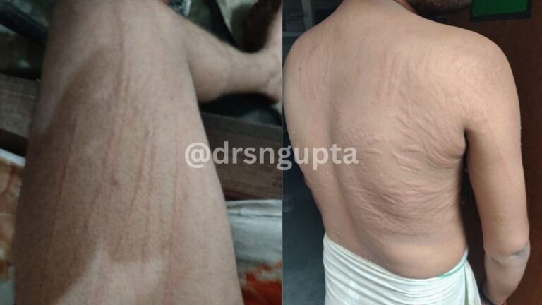 Urticaria and Dermographism Hives and “Skin Writing”