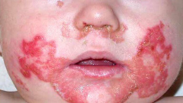 Acrodermatitis Enteropathica Pathogenesis, Clinical Manifestations, Diagnosis, and Management