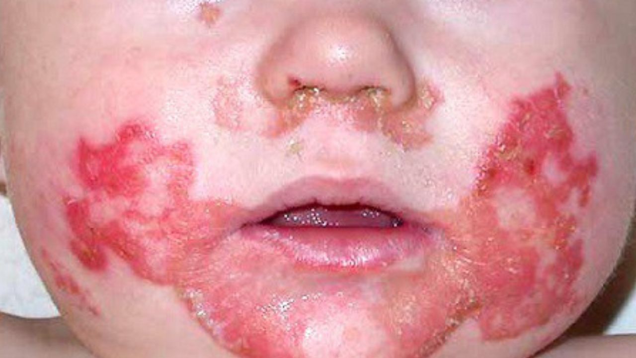 Acrodermatitis Enteropathica Pathogenesis, Clinical Manifestations, Diagnosis, and Management
