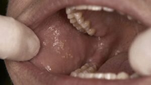 Fordyce Spots Causes, Symptoms, and Safe Treatment - Dr S. N. Gupta