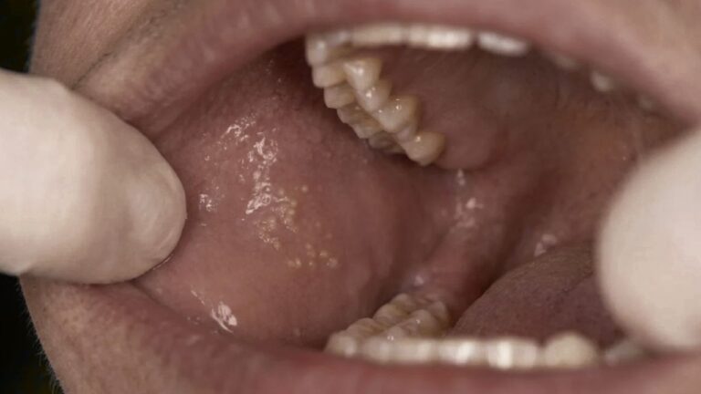 Fordyce Spots Causes, Symptoms, and Safe Treatment - Dr S. N. Gupta