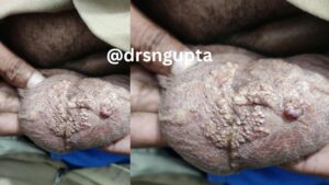 Lymphangioma- causes , symtoms and treatment