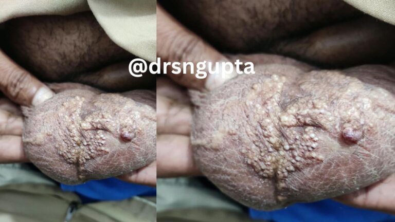 Lymphangioma- causes , symtoms and treatment