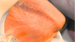 Pearly Penile Papules (PPP) What You Need to Know - Dr S. N. Gupta