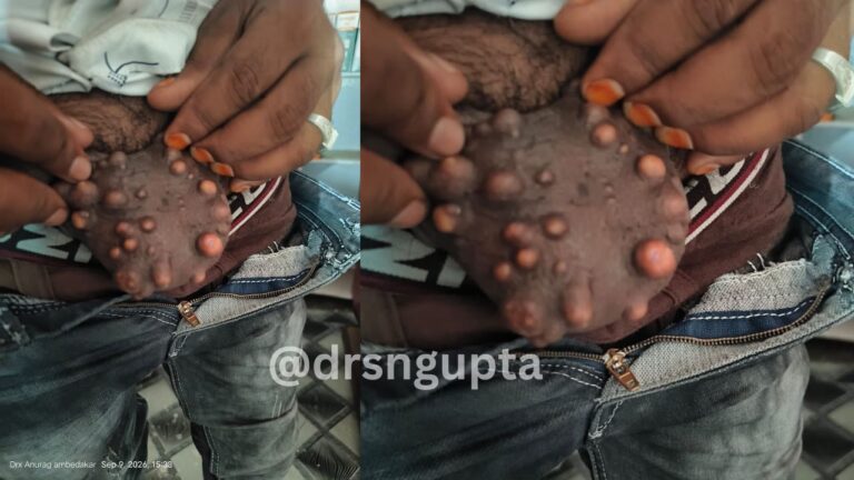 Scrotal Cysts Causes, Types, Symptoms, Diagnosis,Treatment - Dr S. N. Gupta
