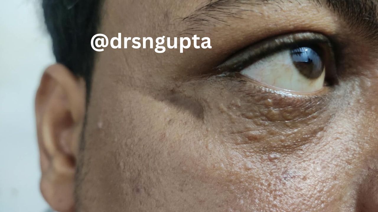 Syringoma