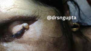 Understanding Hydrocystoma Causes, Symptoms, Types, and Advanced Treatment Options