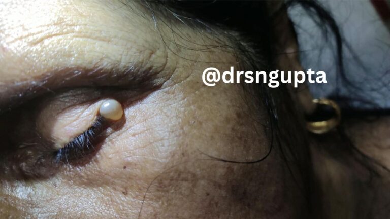 Understanding Hydrocystoma Causes, Symptoms, Types, and Advanced Treatment Options